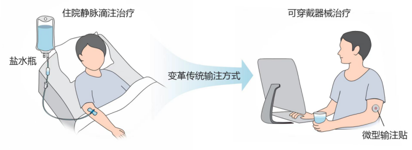 有望和传统挂水输液法说再见！科学家研发大剂量药物输注贴